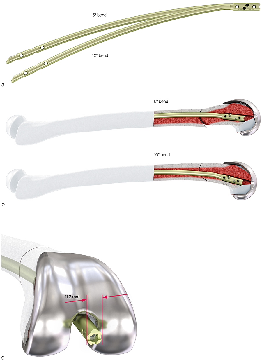 Anterograde Removal of Broken Femoral Nails without Opening the Nonunion  Site: A New Technique | Clinics